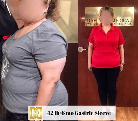 Bariatric / Gastric Bypass Surgeons Near Me in Beverly Hills, CA .